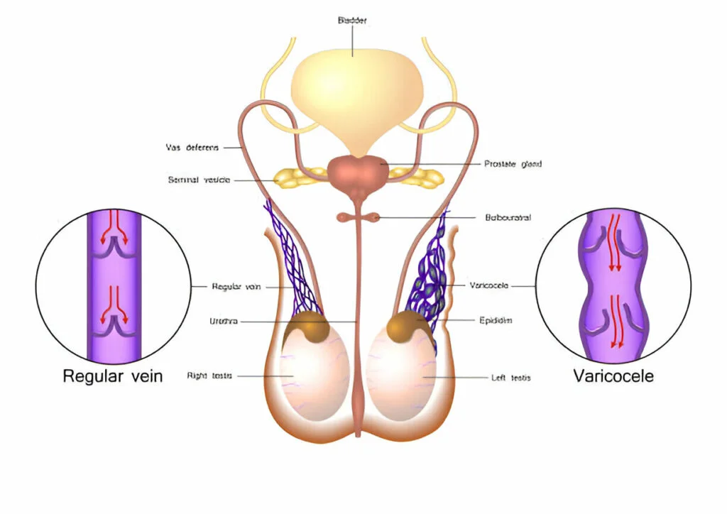 Understanding varicocele